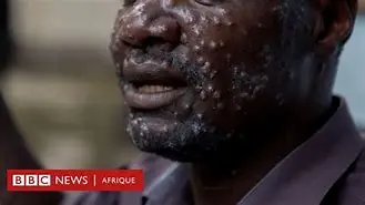 Image for Mpox (anciennement variole du singe) : Ce qu'il faut savoir